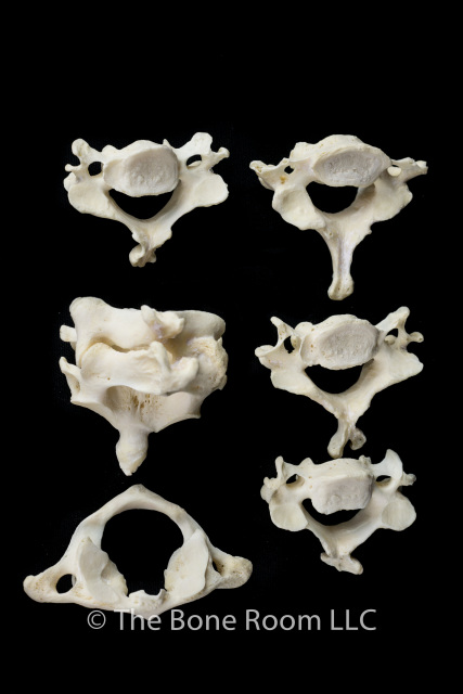 Pathological Human Skull #2000 - Male (w/ Cervical Vertebrae & Dental ...