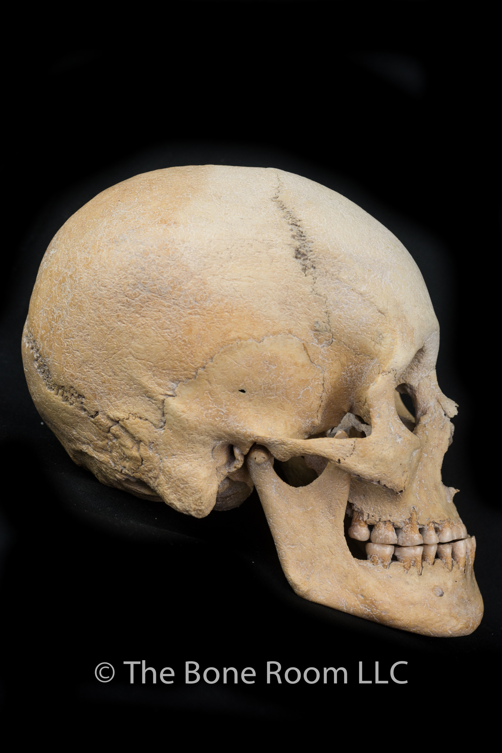 Pathological Human Skull #1102 - Male