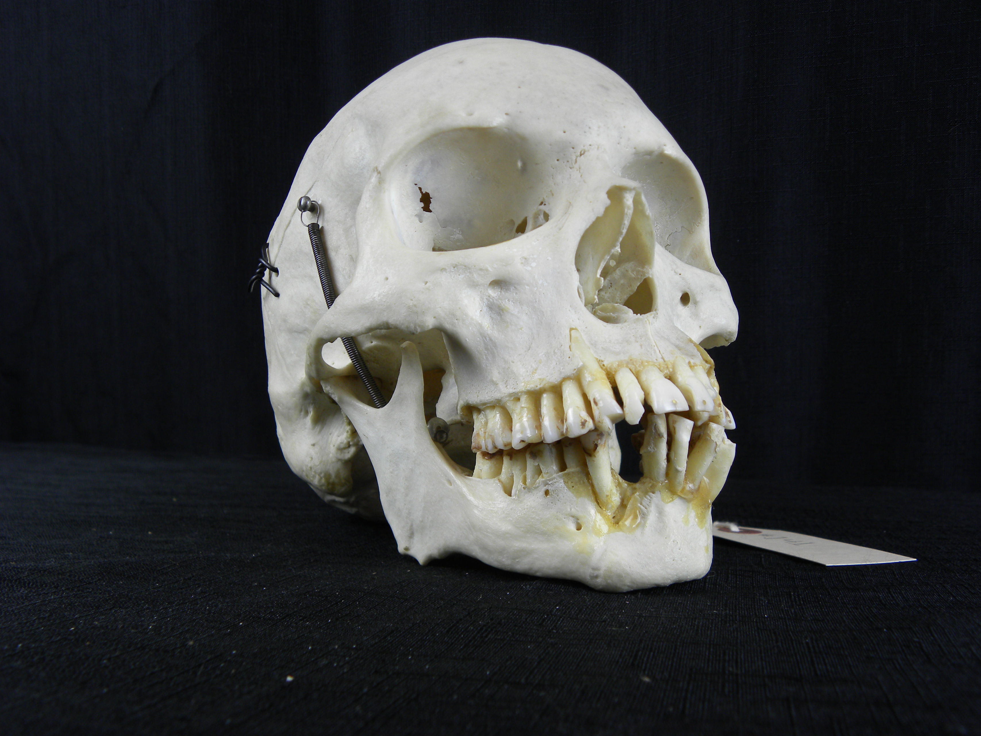 141 Pathological human skull